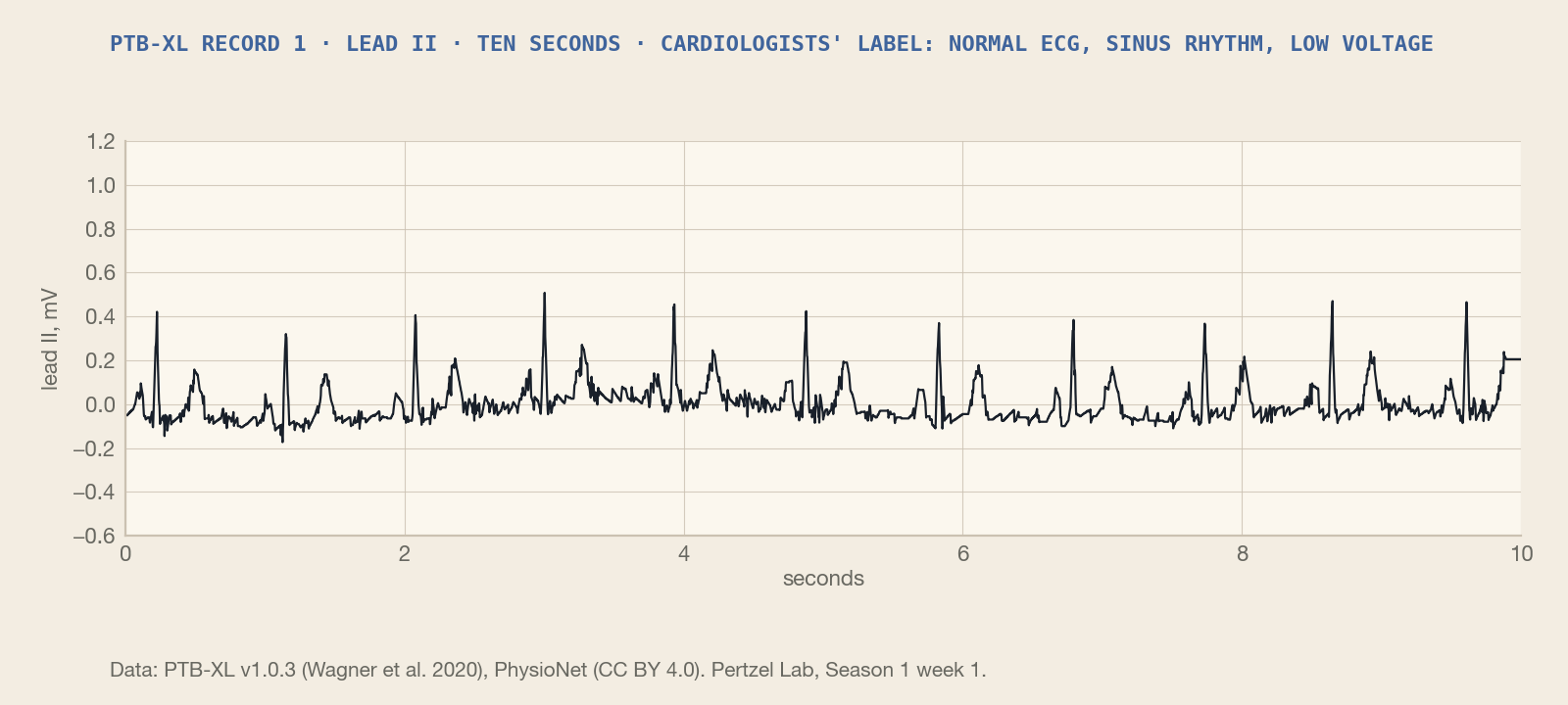 A real ten-second ECG trace from PTB-XL record 1, lead II
